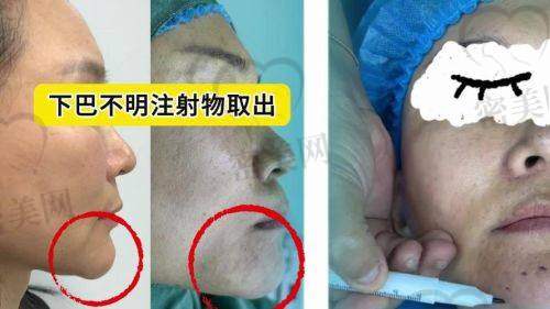 宝子们，一起冲王阔远医生的馒化脸修复