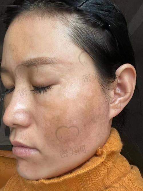 合肥华美整形美容医院：皮秒祛斑实力在线