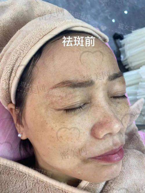 祛斑不能只看价格，更重要的是长期性价比