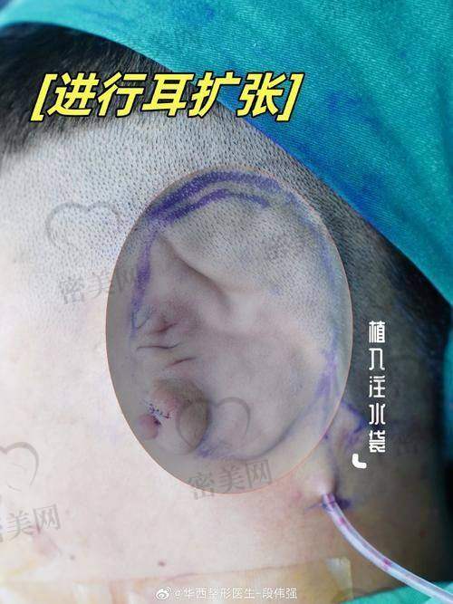 上海海华医院李营耳再造：口碑爆棚的秘密