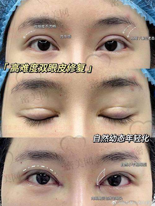 为什么大家都找成都高亮医生做初眼整形？技术细节决定一切！