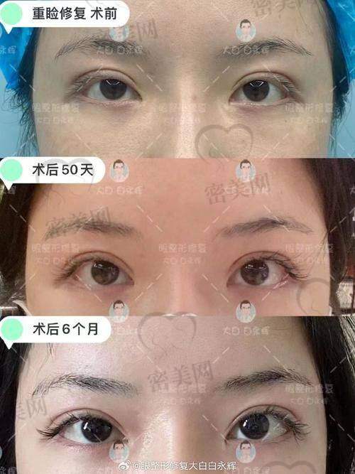真实双眼皮修复实例反馈：术后自然好看到“同事都没看出来”