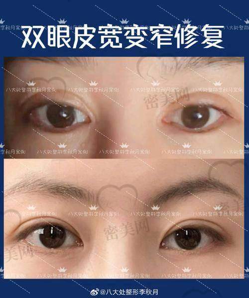 张园园为什么双眼皮修复这么受欢迎？术后成效+服务体验双加分