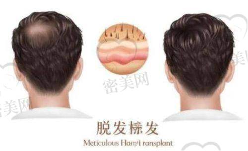 怎么判断自己该不该植发？
