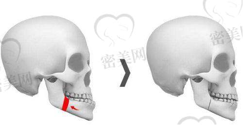广州艾伟健医生正颌经验多，几万例实例不是吹出来的