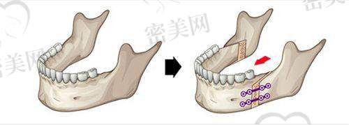 5-13万元正颌手术到底值不值？从多个维度解构