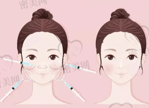 赵作钧医生:吸脂+脂肪填充塑形双绝技医生