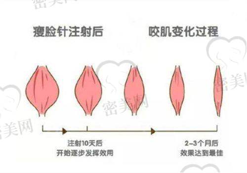 瘦脸针价格大揭秘