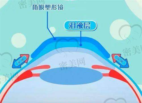 北京爱尔英智眼科医院：段安丽切口稳定，副反应轻微