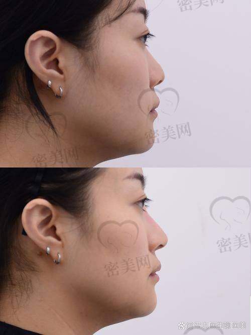 深圳张辉医生做鼻子怎么样？实战经验 + 真实实例 + 口碑反馈 = 值得选择