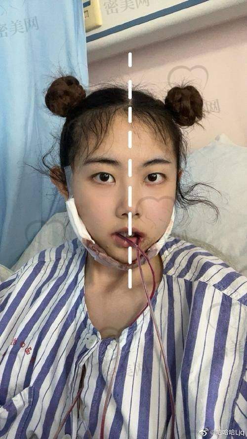 广州艾伟健正颌手术真实实例详解：术前术后对比明显