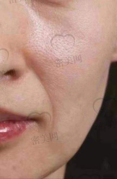 玻尿酸填充法令纹后硬块消除时间
