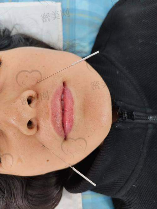 玻尿酸填充其他部位的费用揭秘