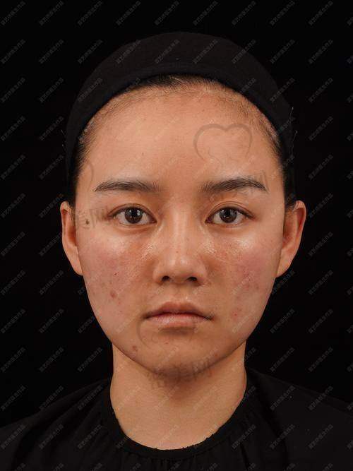 医美产品价格与面部填充材料价格对比