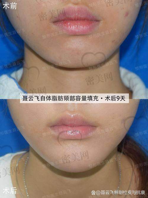 不同年龄段女性适合的整形项目与面部填充的关联