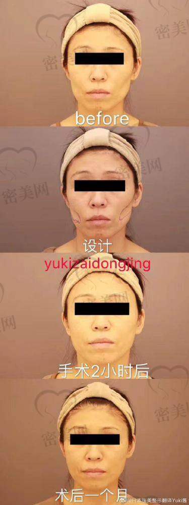 面部填充的注意事项