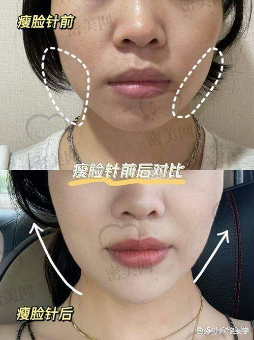 热门整形技术对比：伊蒂美和菲蜜丽私密整形技术
