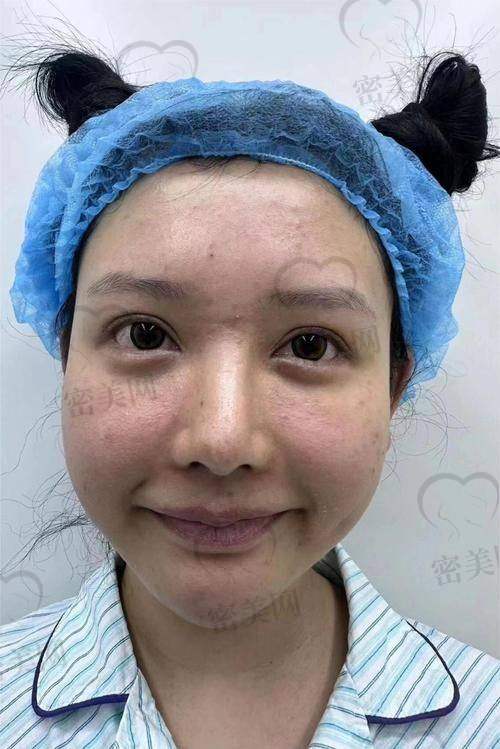 填充后的注意事项