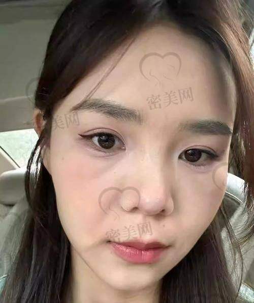 玻尿酸填充脸颊
