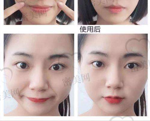 玻尿酸与胶原蛋白填充的对比总结