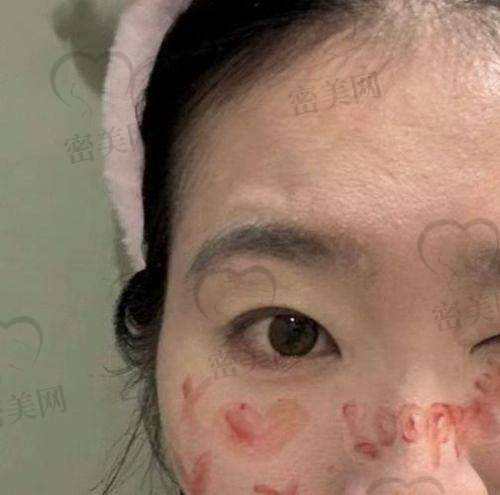 脸颊凹陷的成因及影响
