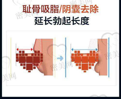 武汉市第一医院激光项目常见问题说明