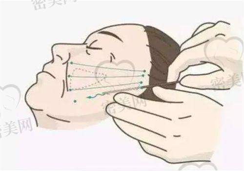 特殊“棉花糖丰胸”技术，术后修复快、成效自然