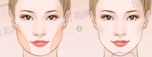 上海九院非手术类整形2025价格曝光（玻尿酸/肉毒/热提拉项目）