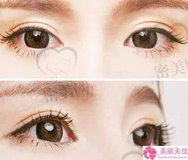 郑州时光整形美容医院：睁眼动态线一绝！
