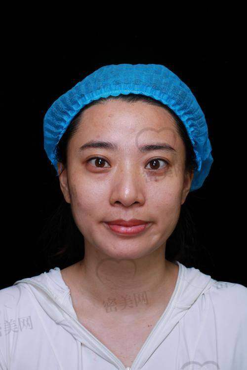 健丽医美不开刀去眼袋技术具体是怎么做的？