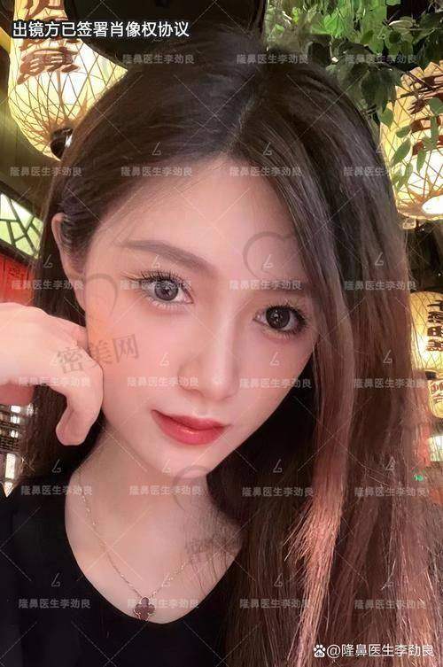 鼻子玻尿酸注射后会变宽吗