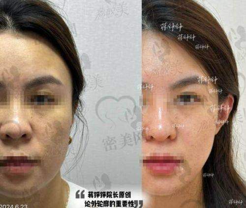 面部填充的注意事项