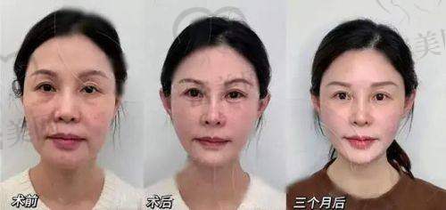 面部填充的热门活动及优惠信息