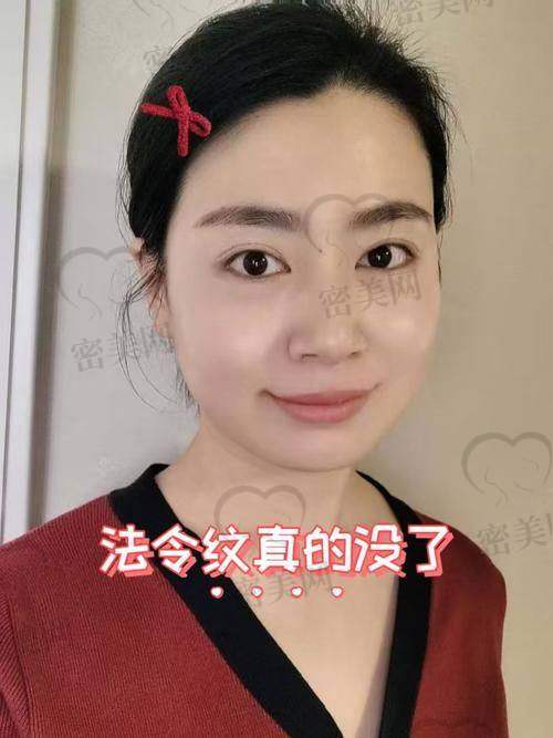 医美机构活动与去除法令纹的关联