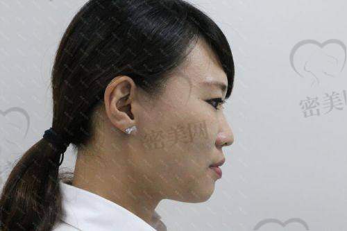 玻尿酸填充下巴——价格、维持时间、后遗症及品牌选择