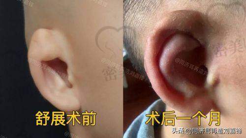 成都润美玉之光整形美容医院：耳形美学精细化雕刻定制