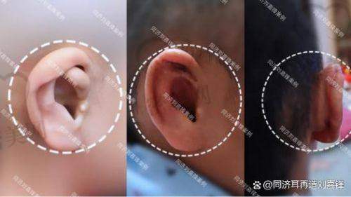 成都恩喜医疗美容医院：综合修复＋二次耳整形好去处