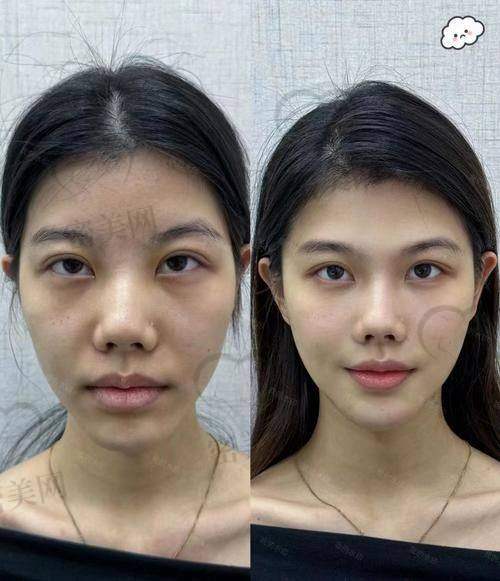 真人日记中的医美体验与玻尿酸