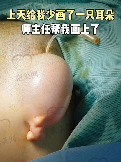 成都壹加壹医疗美容医院：效率高一次耳型成型技术