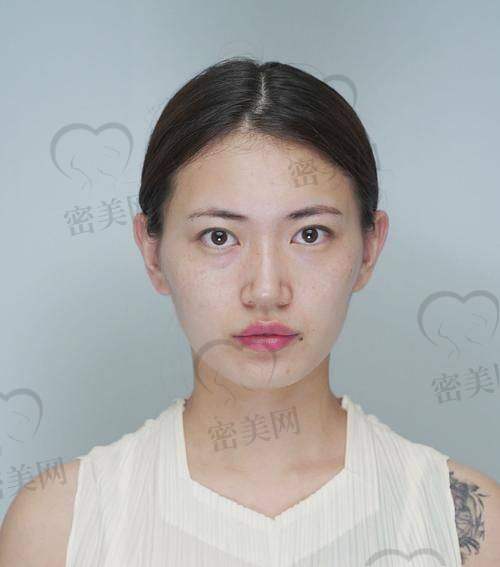 玻尿酸填充