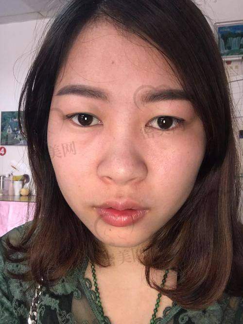 脸部填充整形的注意事项
