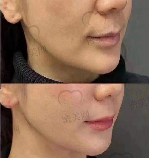 玻尿酸填充的优缺点及危害