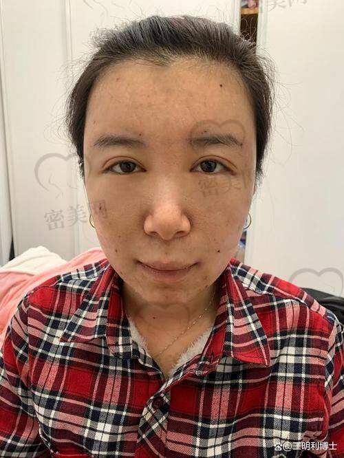 脂肪填充