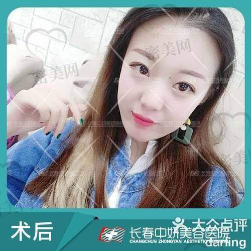 眼窝凹陷填充材料大揭秘