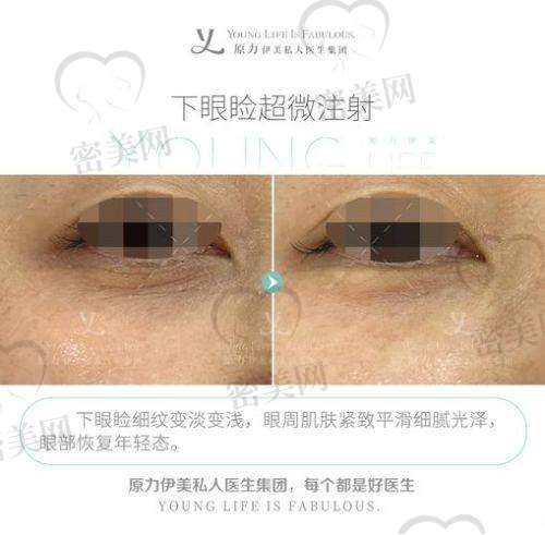 眼窝凹陷填充的费用