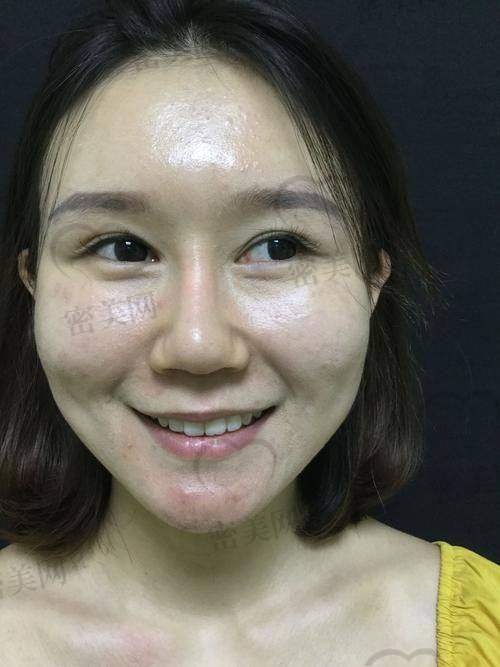 眼窝凹陷的原因