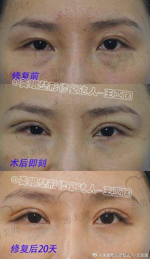 重庆松山整形医院段艳军：9800 元开启双眼皮修复低价风暴