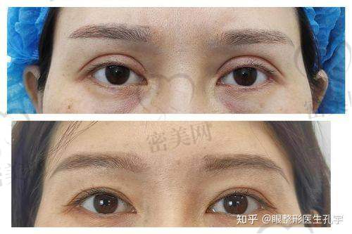 重庆松山整形医院段艳军双眼皮修复：真人实例见证奇迹