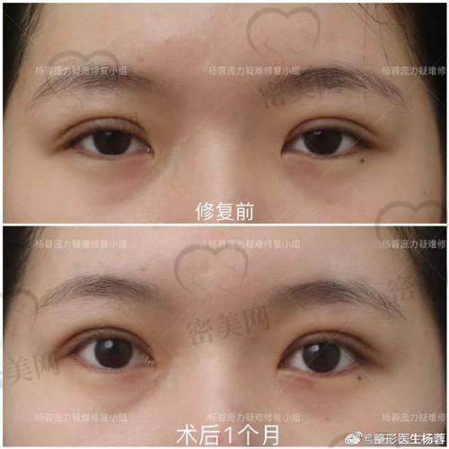 重度失败双眼皮，我的“噩梦”开端