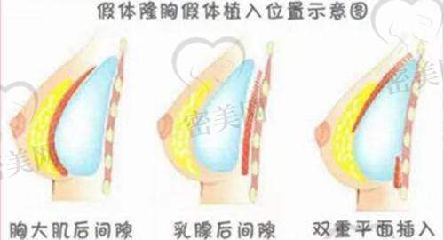 【李超医生擅长项目】